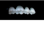 Cod.E4LOWER LEFT: 15x  posterior hollow wax veneers-bridges, X-SMALL, (34-37), with precarved occlusion to Cod.E4UPPER LEFT, and compatible to Cod.S4LOWER LEFT (solid), (34-37)